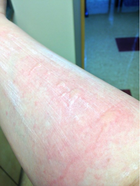 Aleen's Allergy Tested Arm